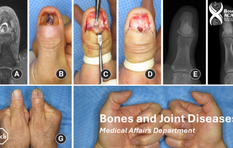 Bones & Joints Diseases